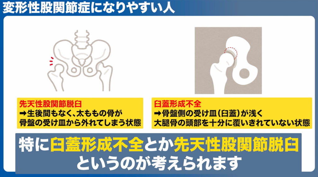 変形性股関節症になりやすい人
